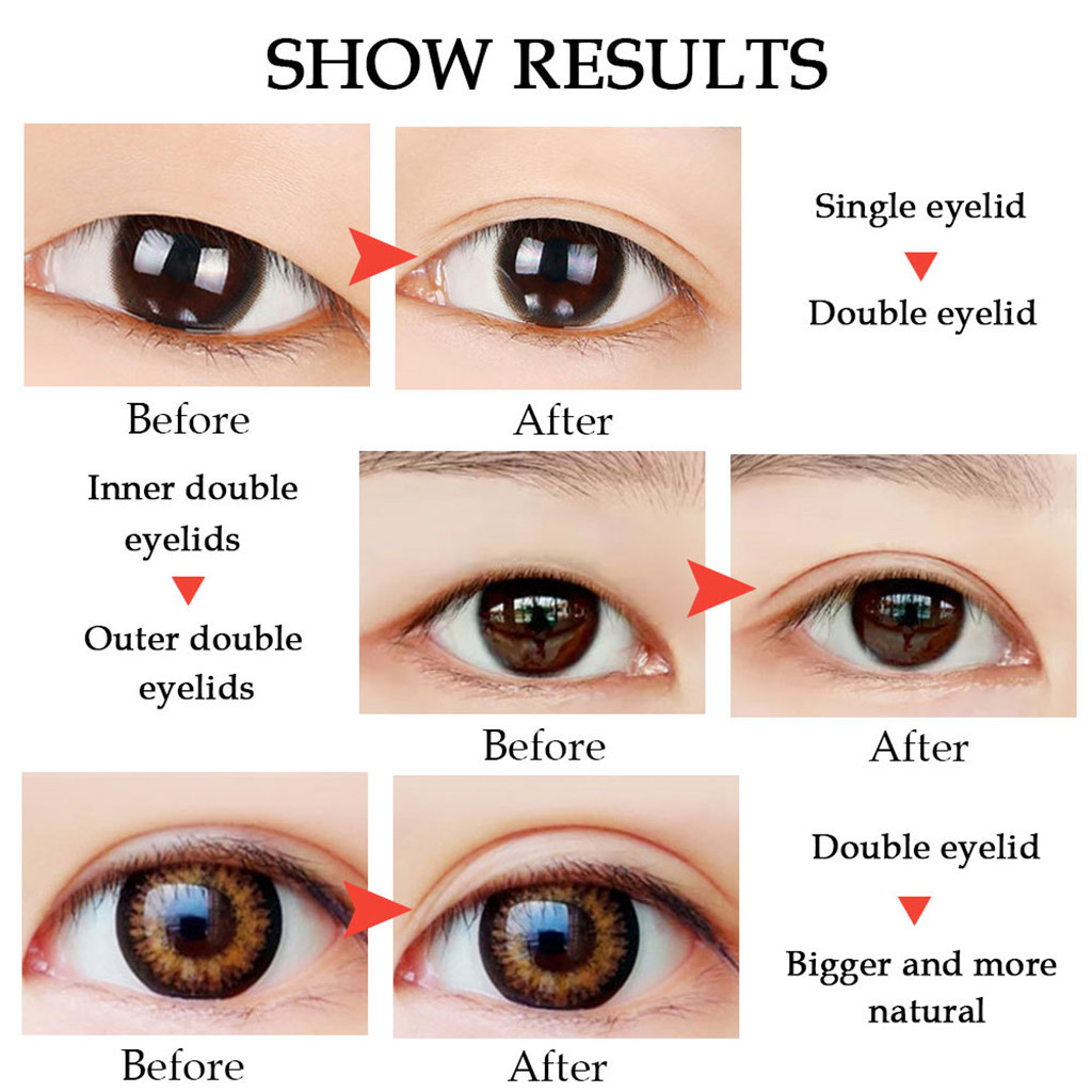 difference between single and double eyelids