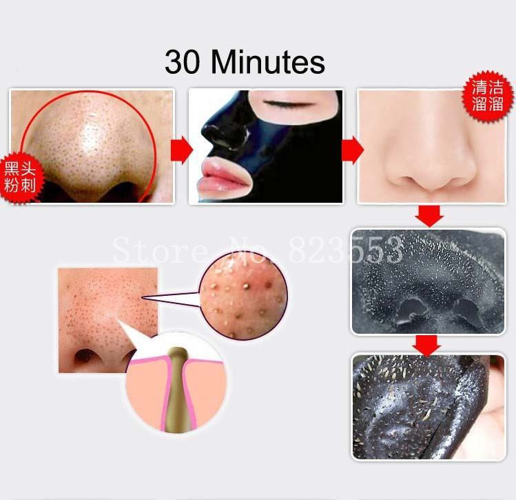 nose_Blackhead-5