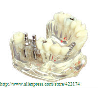 Free Shipping Implant model with bridge and caries for dentist communication dental tooth teeth dentist anatomical anatomy model
