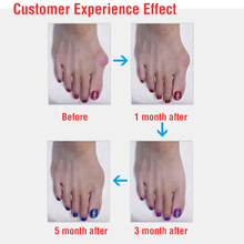 3Pair Sub toe toe braces Toe Separator Orthoses Hallux Valgus Beauty Health Braces foot care