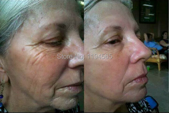 2pcs 2X10ml Boto x Instantly Ageless Face Lift Firming Skin Care Product Concentrate Powerful Anti wrinkle