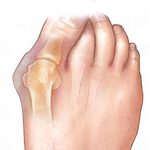 1Pair Sub toe toe braces Toe Separator Orthoses Beauty Health Braces Hallux Valgus Corrector