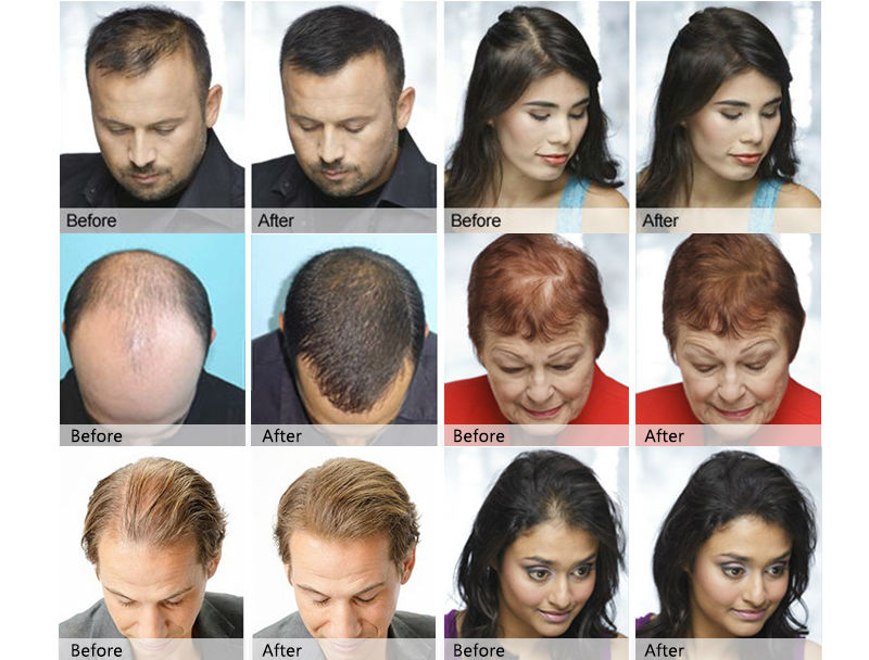 Image result for hair growth spray before and after