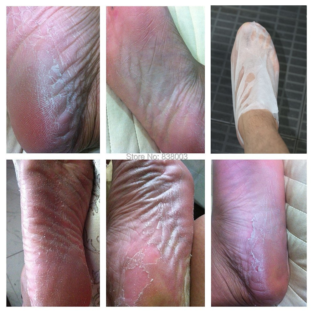 7pair=14pieceslot beely Bamboo Vinegar Remove Dead Skin Milk Foot Mask Peeling Cuticles Heel Feet Care pedicure socks sosu (3).jpg