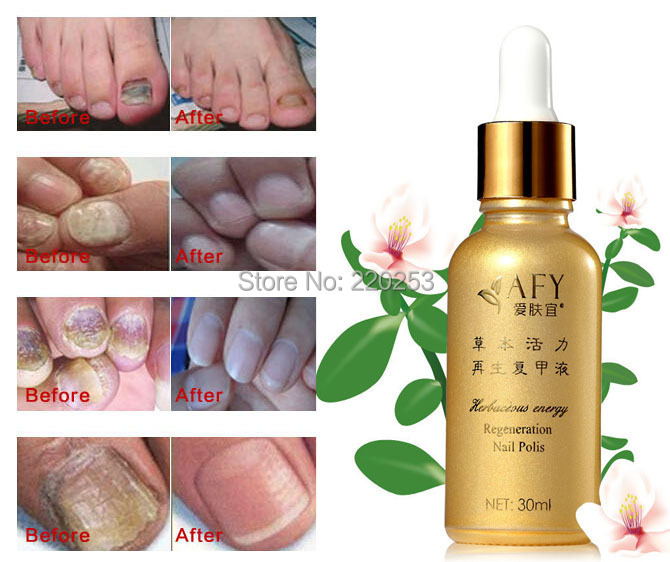 AFY Fungal Nail Treatment Essence Oil Hand and Foot Whitening Toe Nail Fungus Removal Feet Care