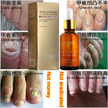 100 Original SnazII Fungal Nail Treatment Essence Nail and Foot Whitening Toe Nail Fungus ProfessionRemoval Feet
