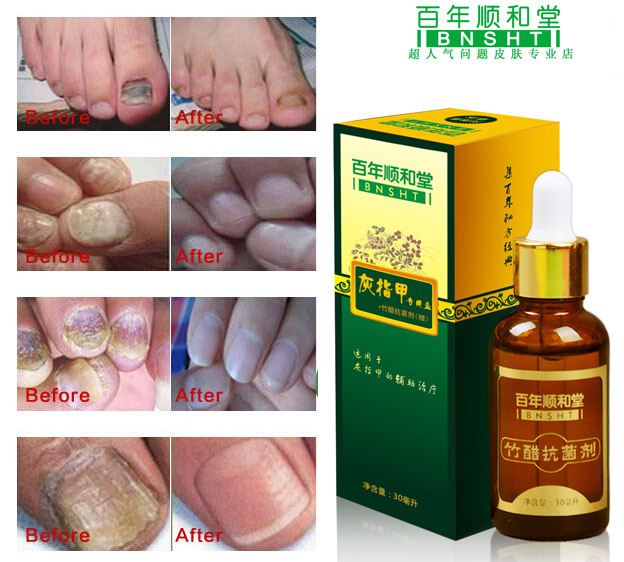 Fungal Nail Treatments Herbal Essence Nail and Foot Whitening Toe Nail Fungus Removal Feet Care Nail