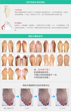 10Pairs Medical Silica Gel Beetle crusher Bone Ectropion Toes outer Appliance Professional Technology Health Care Product