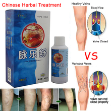 Vasculitis spray ,Varicose veins treatment spray on leg acid bilges itching earthworm lumps bad leg cure natural solution