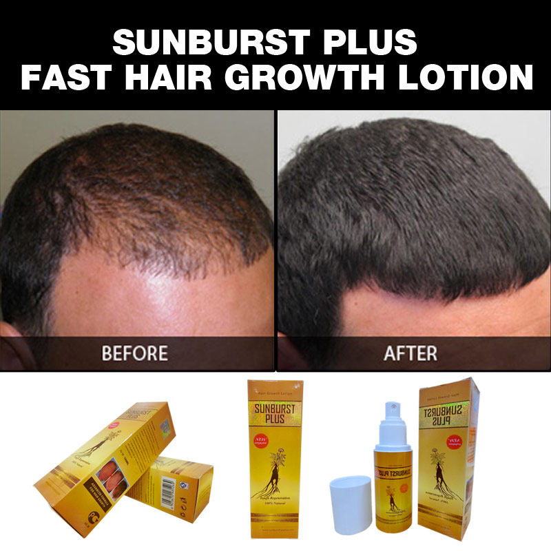 3 bottles Sunburst Plus Hair Growth Lotion NEW UPGRADE 100ml fast hair
