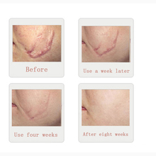 1pcsPowerful And Safe Remove Scar Cream Scar Removal Acne Spots Remove Striae Gravidarum Skin Care 