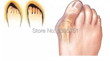 2pair New Hotsale Beetle crusher Bone Ectropion Toes outer Appliance Professional Technology Health Care Products